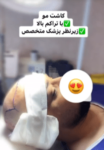 نمونه کاشت مو دکتر محمود جعفری (کلینیک رز سفید)