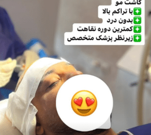 نمونه کاشت مو دکتر محمود جعفری (کلینیک رز سفید)