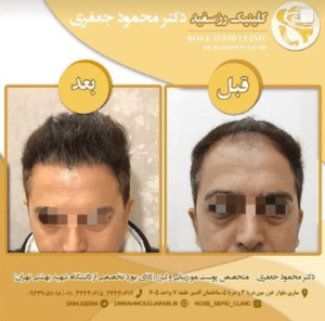 نمونه کاشت مو دکتر محمود جعفری (کلینیک رز سفید)