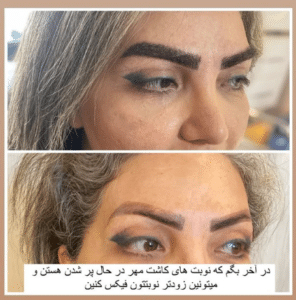 نمونه کاشت ابرو دکتر محمود جعفری (کلینیک رز سفید)
