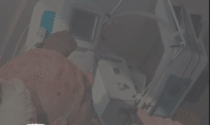 نمونه کاشت مو دکتر محمود جعفری (کلینیک رز سفید)