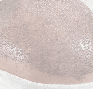 نمونه کاشت مو دکتر محمود جعفری (کلینیک رز سفید)