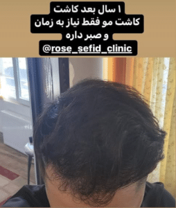 نمونه کاشت مو دکتر محمود جعفری (کلینیک رز سفید)