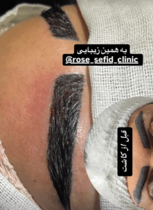 نمونه کاشت ابرو دکتر محمود جعفری (کلینیک رز سفید)