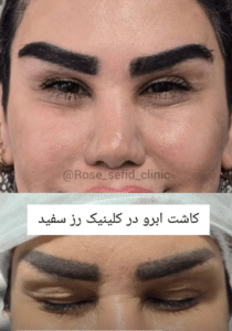 نمونه کاشت ابرو دکتر محمود جعفری (کلینیک رز سفید)