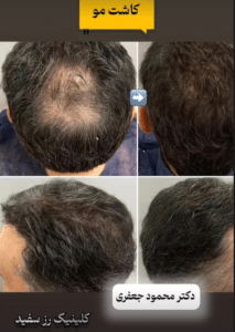نمونه کاشت مو دکتر محمود جعفری (کلینیک رز سفید)