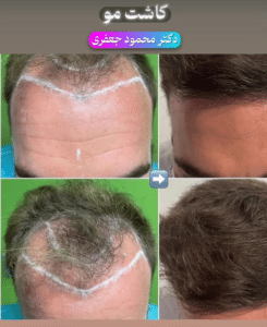 نمونه کاشت مو دکتر محمود جعفری (کلینیک رز سفید)