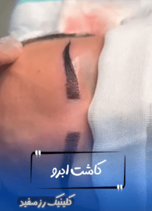 نمونه کاشت ابرو دکتر محمود جعفری (کلینیک رز سفید)