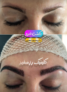 نمونه کاشت ابرو دکتر محمود جعفری (کلینیک رز سفید)