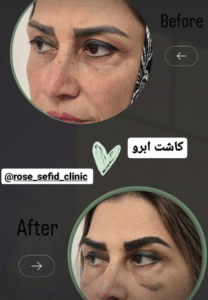 نمونه کاشت ابرو دکتر محمود جعفری (کلینیک رز سفید)