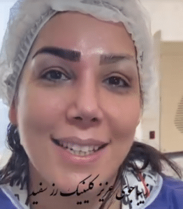 نمونه کاشت ابرو دکتر محمود جعفری (کلینیک رز سفید)