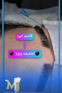 نمونه کاشت ابرو دکتر محمود جعفری (کلینیک رز سفید)