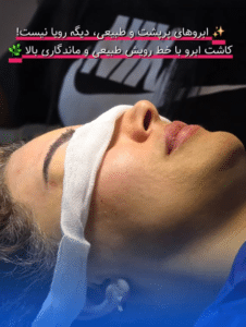 نمونه کاشت ابرو دکتر محمود جعفری (کلینیک رز سفید)