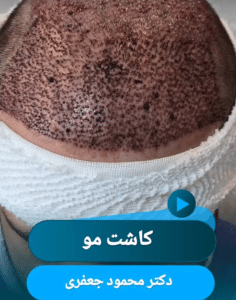 نمونه کاشت مو دکتر محمود جعفری (کلینیک رز سفید)
