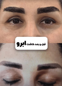 نمونه کاشت ابرو دکتر محمود جعفری (کلینیک رز سفید)
