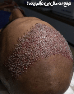 نمونه کاشت مو دکتر محمود جعفری (کلینیک رز سفید)