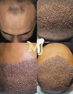 نمونه کاشت مو دکتر محمود جعفری (کلینیک رز سفید)