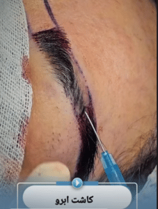نمونه کاشت ابرو دکتر محمود جعفری (کلینیک رز سفید)