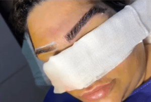 نمونه کاشت ابرو دکتر محمود جعفری (کلینیک رز سفید)