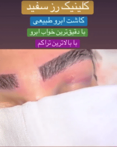 نمونه کاشت ابرو دکتر محمود جعفری (کلینیک رز سفید)