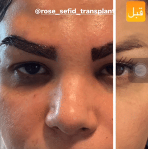 نمونه کاشت ابرو دکتر محمود جعفری (کلینیک رز سفید)