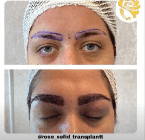 نمونه کاشت ابرو دکتر محمود جعفری (کلینیک رز سفید)