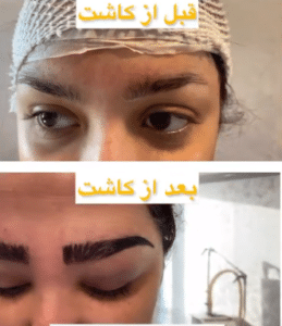 نمونه کاشت ابرو دکتر محمود جعفری (کلینیک رز سفید)