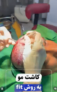 نمونه کاشت مو دکتر قاسم رحمت پور رکنی
