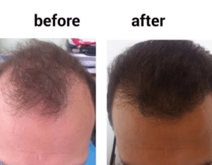 نمونه کاشت مو دکتر قاسم رحمت پور رکنی