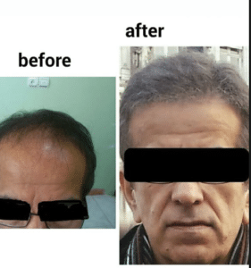 نمونه کاشت مو دکتر قاسم رحمت پور رکنی