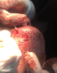 نمونه کاشت مو دکتر قاسم رحمت پور رکنی