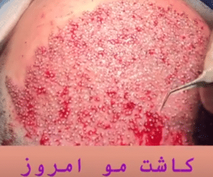 نمونه کاشت مو دکتر قاسم رحمت پور رکنی