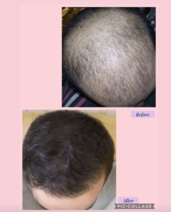 نمونه کاشت مو دکتر قاسم رحمت پور رکنی