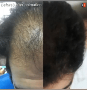 نمونه کاشت مو دکتر قاسم رحمت پور رکنی