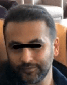 نمونه کاشت مو دکتر قاسم رحمت پور رکنی