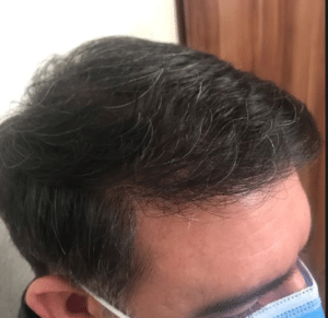 نمونه کاشت مو دکتر قاسم رحمت پور رکنی