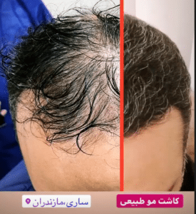 نمونه کاشت مو دکتر قاسم رحمت پور رکنی