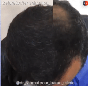 نمونه کاشت مو دکتر قاسم رحمت پور رکنی