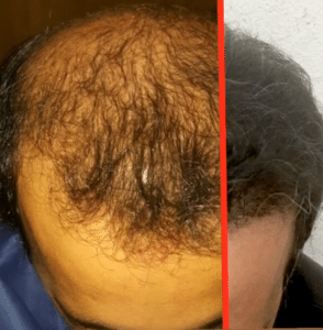 نمونه کاشت مو دکتر قاسم رحمت پور رکنی