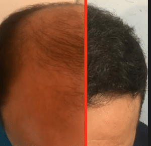 نمونه کاشت مو دکتر قاسم رحمت پور رکنی