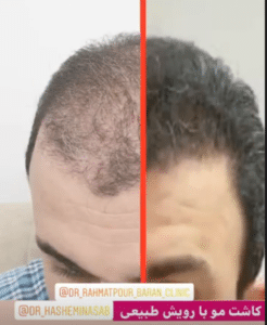 نمونه کاشت مو دکتر قاسم رحمت پور رکنی