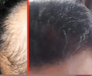 نمونه کاشت مو دکتر قاسم رحمت پور رکنی