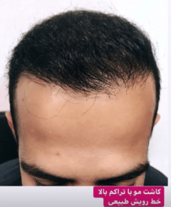 نمونه کاشت مو دکتر قاسم رحمت پور رکنی