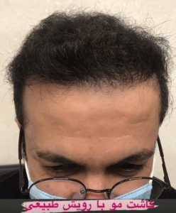 نمونه کاشت مو دکتر قاسم رحمت پور رکنی