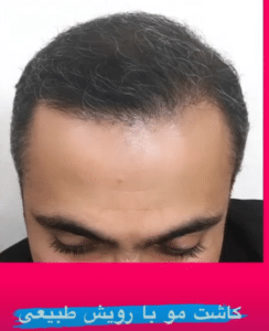 نمونه کاشت مو دکتر قاسم رحمت پور رکنی