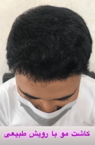 نمونه کاشت مو دکتر قاسم رحمت پور رکنی