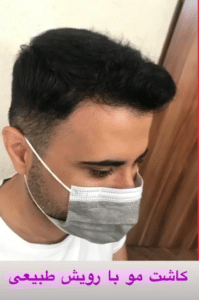 نمونه کاشت مو دکتر قاسم رحمت پور رکنی