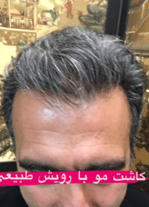 نمونه کاشت مو دکتر قاسم رحمت پور رکنی