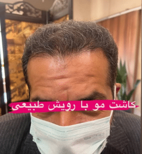 نمونه کاشت مو دکتر قاسم رحمت پور رکنی