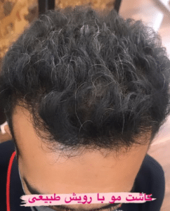نمونه کاشت مو دکتر قاسم رحمت پور رکنی